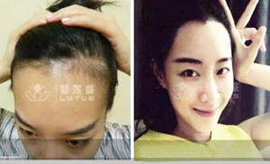 通过织发能得到美人尖吗