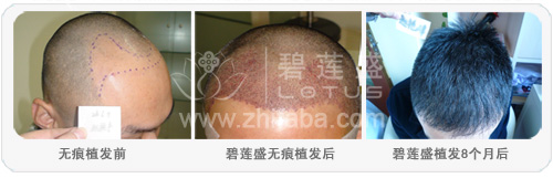 碧莲盛植发案例效果.jpg