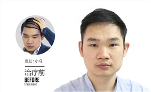 植发过程视频中都有哪些步骤