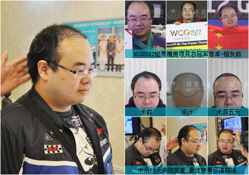 种<em>额角</em>手术价位是多少 - 碧莲盛无痕植发最好的