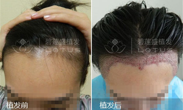 种植头发多少钱一根 植发单位一个多少钱-碧莲