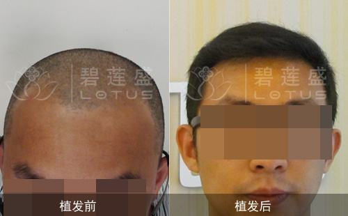 成都植发一般收费多少钱
