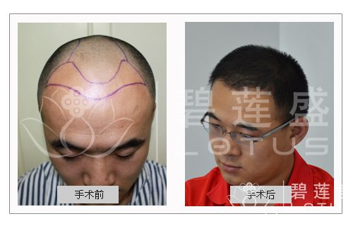 植发后遗症_植发的危害_碧莲盛无痕植发医院