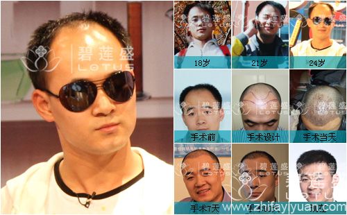 昆明<em>哪里有种植头发的</em> - 碧莲盛无痕植发最好的