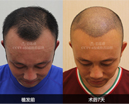 济南植发医院有哪些 济南植头发医院哪家好