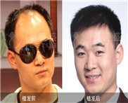 阳光大男孩植发录:首次植发(视频)