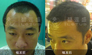 疤痕植发修复成功率高吗