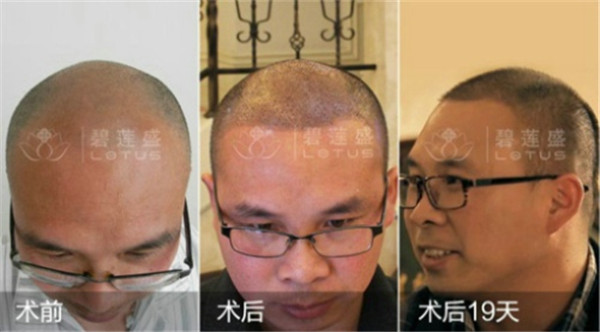 疤痕植发修复成功率高不高