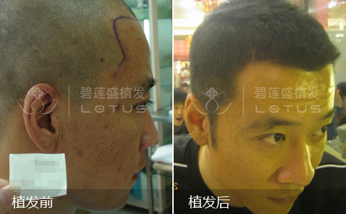 额头两侧鬓角脱发植发手术后效果惊人!