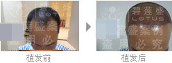 戴先生在碧莲盛植发后当天效果图