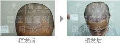 北京哪里做二级脱发植发效果好?