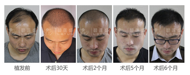 发际线偏高调整案例恢复效果图