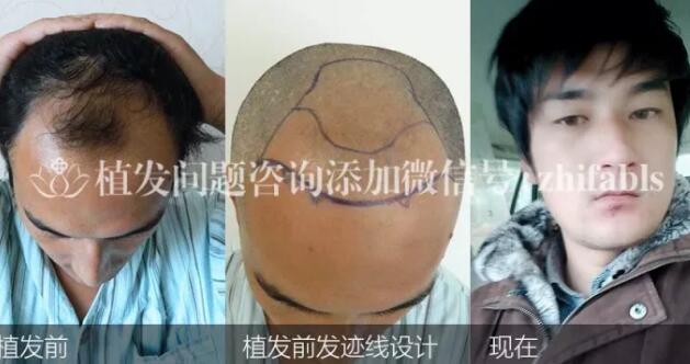发际线种头发调整前后对比案例效果多明显