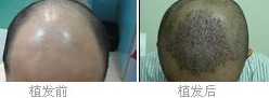 治疗六级脱发植发手术该不该相信?