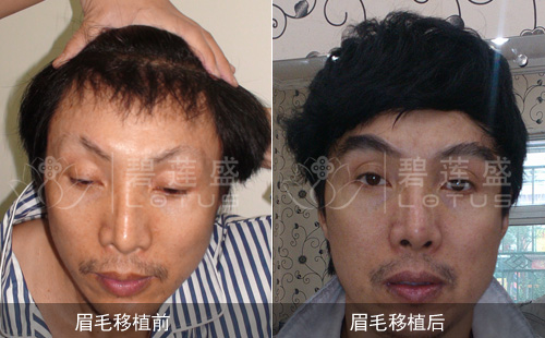 眉毛残缺(男)案例:眉毛种植术后当天