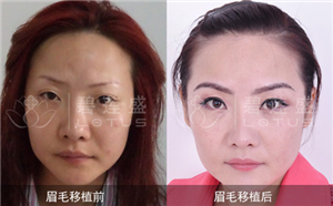 阴毛种植成功解决女性不长阴毛案例