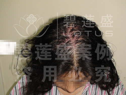 <em>女性</em>头发少是否适合植发 - 碧莲盛无痕<em>植发最好的医院</em>
