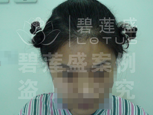 <em>女性植发</em>八个月效果 - 碧莲盛无痕<em>植发</em>最好的医