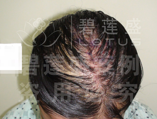 <em>女性</em>稀疏痕<em>植发加密</em>1200单位前后照片 - 碧莲