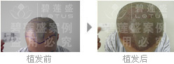 为什么三级脱发种植完之后不会再脱落?