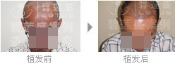 发生三级脱发的过程中有什么症状吗