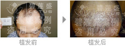 在四级脱发植发之后还需要吃药维持效果吗?