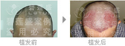 做四级脱发植发怎么算费用?