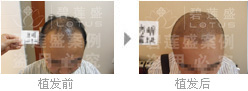 为什么四级脱发都去做植发手术?