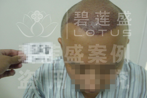 5级脱发植发当天