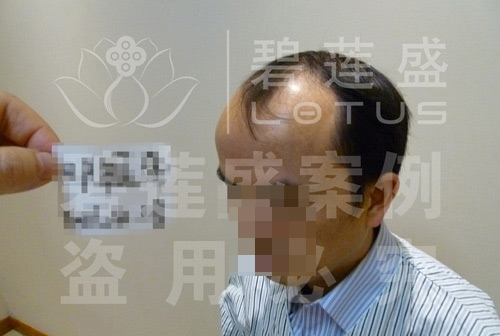 在碧莲盛植发前