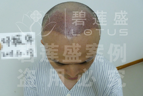 在碧莲盛植发后