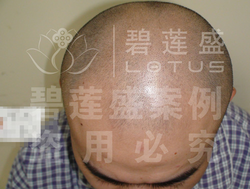 5级脱发者植发当天前后对比 - 碧莲盛无痕植发