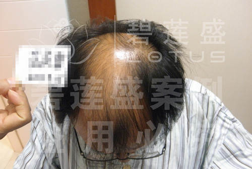 5级脱发植发前