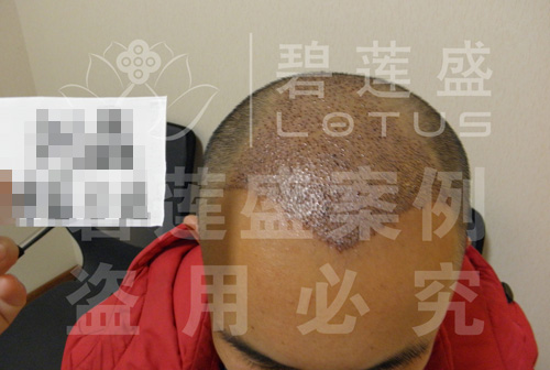 5级脱发植发后