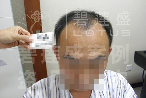 5级脱发照片
