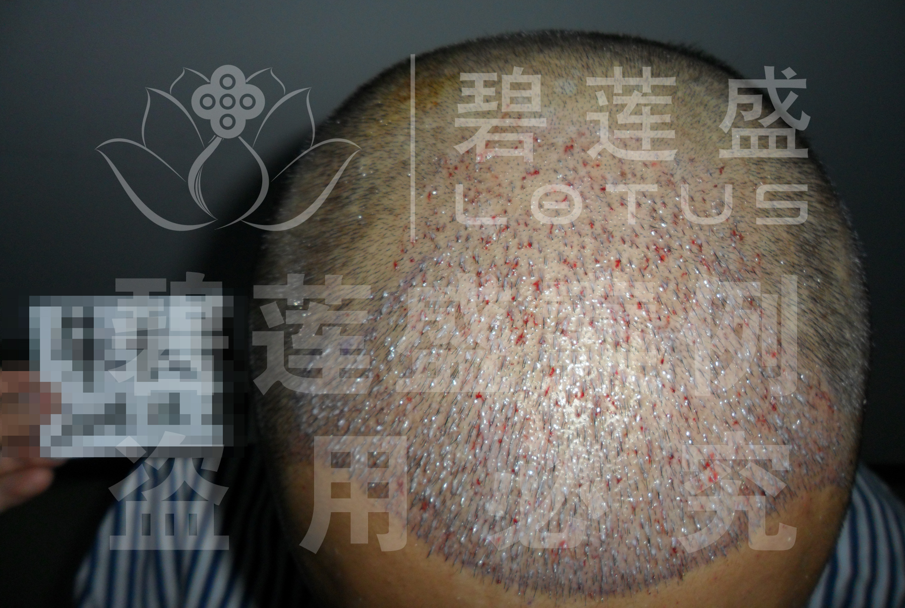 植发3000单位效果图