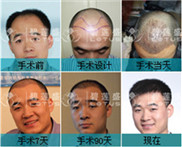 植发三十天效果怎么样?南京碧莲盛植发的效果如何?