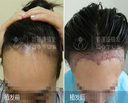 碧莲盛无痕植发多久见效 植发三十天效果如何