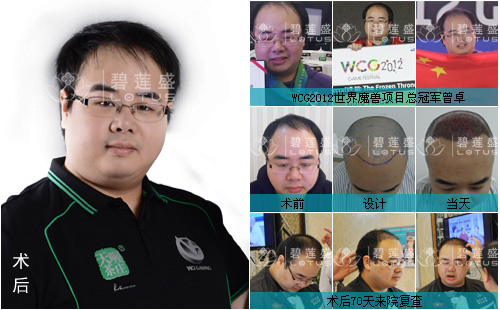 植发会失败导致脱发加重呢
