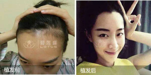 植发失败会有什么特征表现