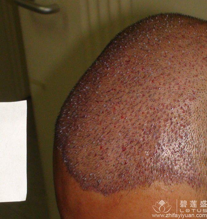 夏先生植发2500单位,显无痕植发效果 - 碧莲盛