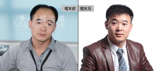 重庆谁调整过发际线,用了多少钱 - 碧莲盛无痕