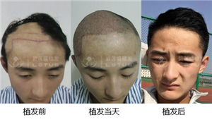 现在哪里做植发效果好