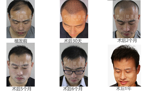 种植的<em>头发</em>还会<em>脱</em>吗 种植后的<em>头发</em>脱落正常吗