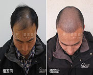 植发治疗秃顶效果怎么样