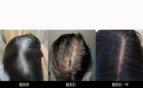 雄性脱发和脂溢性脱发有何关系