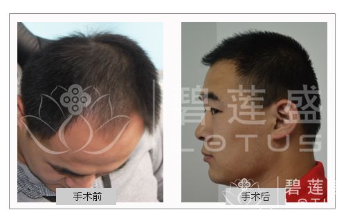 <em>有人种植过头发</em>吗 - 碧莲盛无痕植发最好的医院