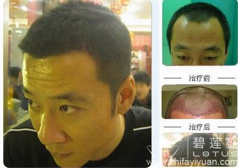 <em>种头发价格</em>大体范围 - 碧莲盛无痕植发最好的医